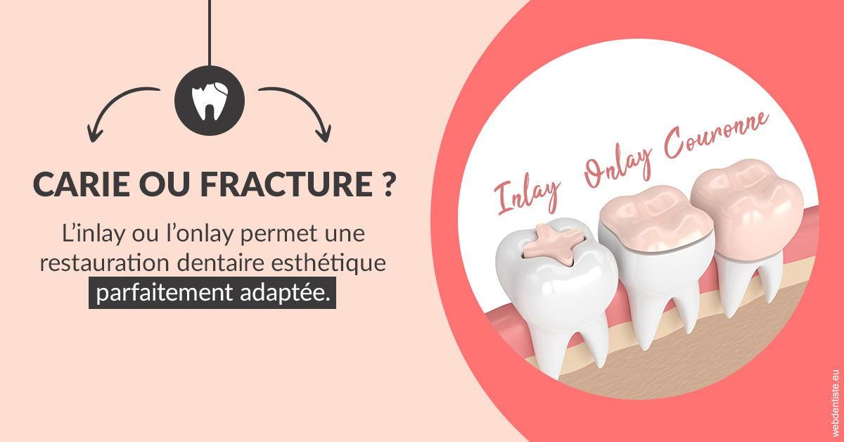 https://dr-santoni-sylvain.chirurgiens-dentistes.fr/T2 2023 - Carie ou fracture 2