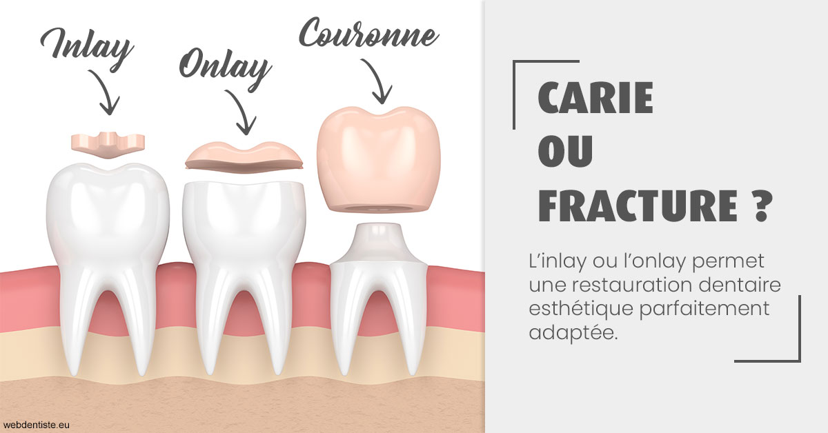 https://dr-santoni-sylvain.chirurgiens-dentistes.fr/T2 2023 - Carie ou fracture 1