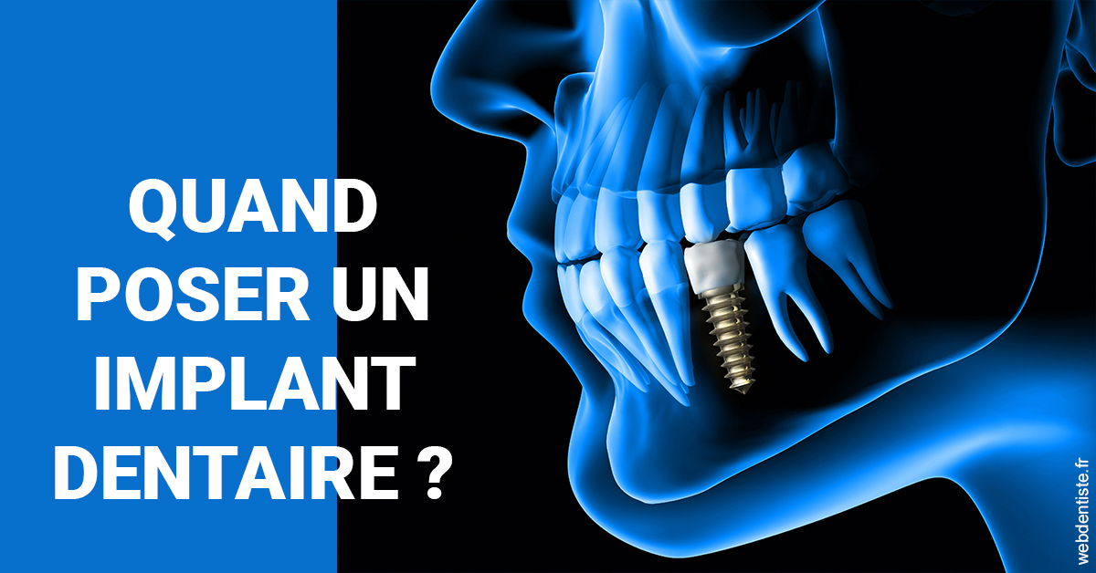 https://dr-santoni-sylvain.chirurgiens-dentistes.fr/Les implants 1