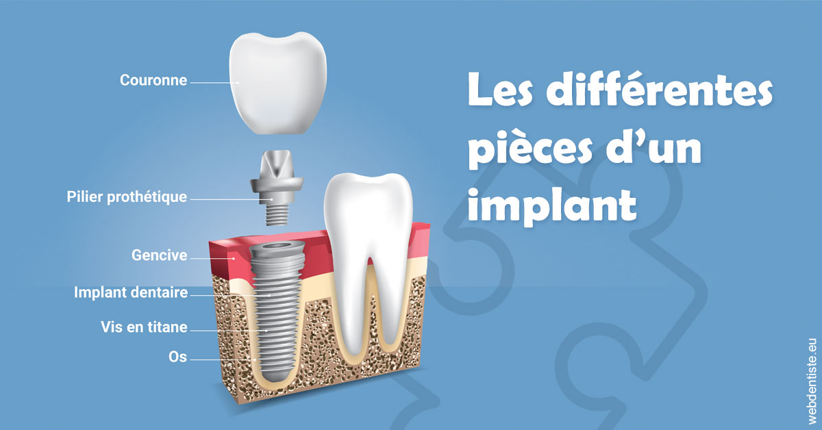 https://dr-santoni-sylvain.chirurgiens-dentistes.fr/Les différentes pièces d’un implant 1